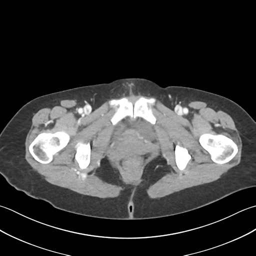 Cecum hernia through the foramen of Winslow (Radiopaedia 46634-51112 A 75).png