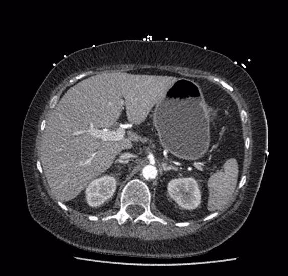 Celiac artery severe stenosis and dissection (Radiopaedia 44128-47842 B 23).jpg