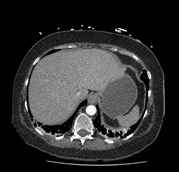 Celiac artery severe stenosis and dissection (Radiopaedia 44128-47842 B 8).jpg