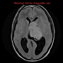 File:Central neurocytoma (Radiopaedia 13188-13206 Axial FLAIR 2).jpg