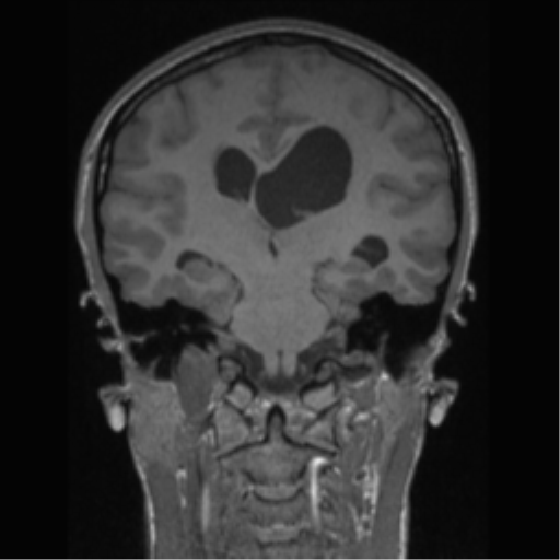 Central neurocytoma (Radiopaedia 37664-39557 Coronal T1 40).png