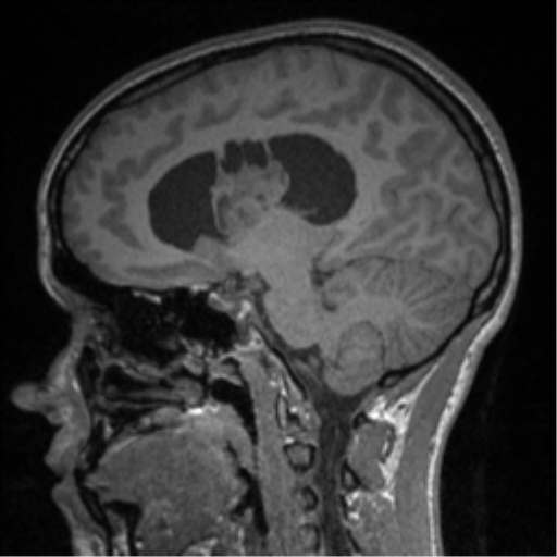 Central neurocytoma (Radiopaedia 37664-39557 Sagittal T1 43).png