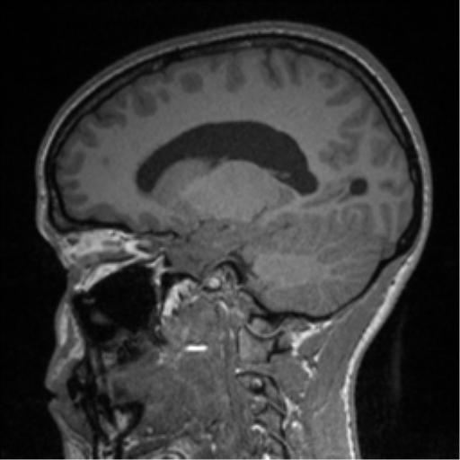 Central neurocytoma (Radiopaedia 37664-39557 Sagittal T1 60).png