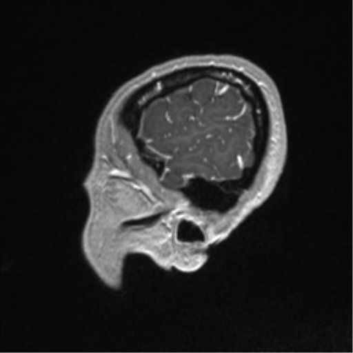 Central neurocytoma (Radiopaedia 37664-39557 Sagittal T1 C+ 85).png