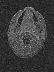 Central neurocytoma (Radiopaedia 56690-63469 Axial T1 C+ 169).jpg