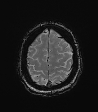 File:Central neurocytoma (Radiopaedia 71068-81303 Axial SWI 57).jpg