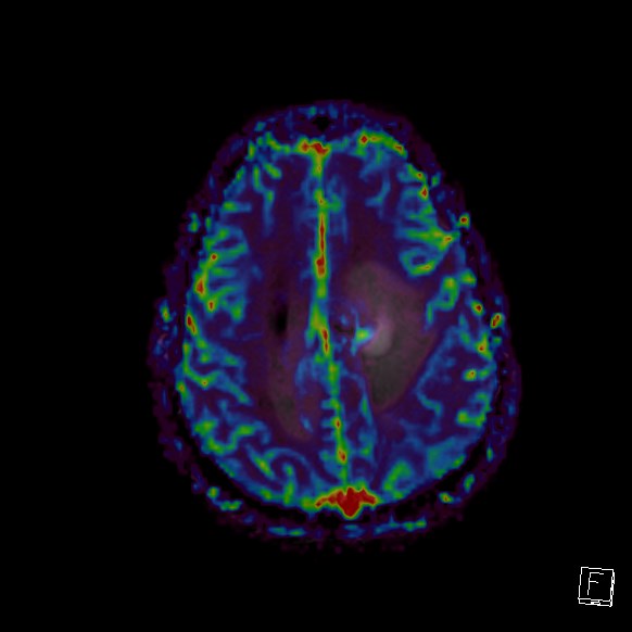 Central neurocytoma (Radiopaedia 84497-99872 Axial Perfusion 89).jpg