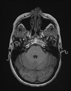 Central neurocytoma (Radiopaedia 84497-99872 Axial T1 58).jpg