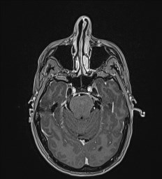 Central neurocytoma (Radiopaedia 84497-99872 Axial T1 C+ 48).jpg