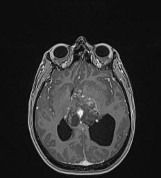 Central neurocytoma (Radiopaedia 84497-99872 Axial T1 C+ 81).jpg