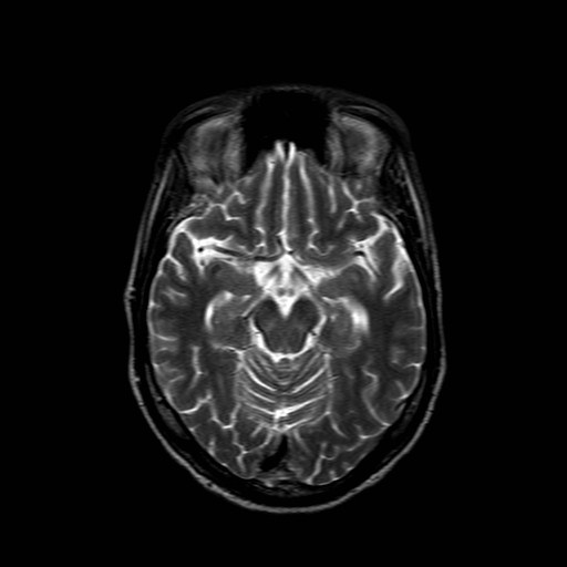 File:Central pontine myelinolysis (Radiopaedia 2598-6296 Axial T2 1).jpg