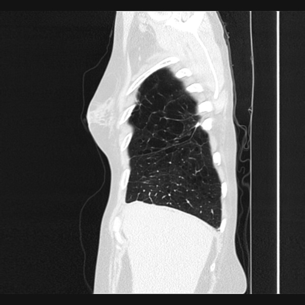 Centrilobular pulmonary emphysema (Radiopaedia 24495-24789 Sagittal lung window 10).jpg