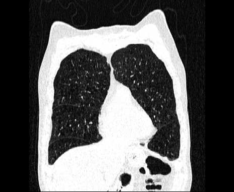 Centrilobular pulmonary emphysema (Radiopaedia 62468-70718 Coronal lung window 17).jpg