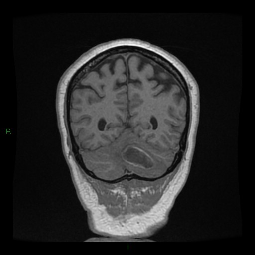 File:Cerebellar abscess (Radiopaedia 78135-90678 Coronal T1 C+ 129).jpg