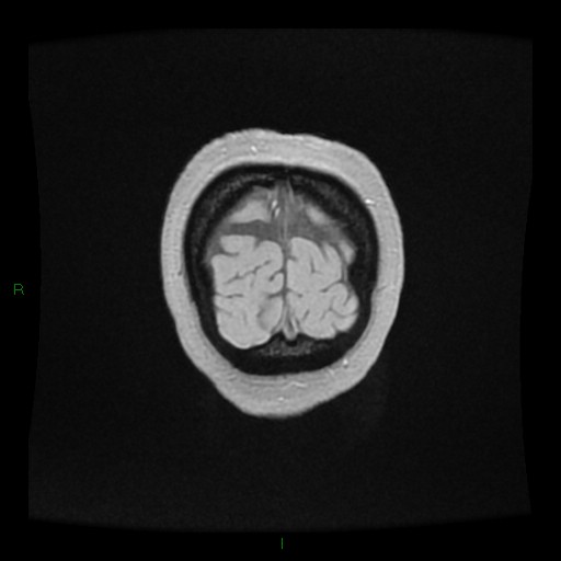 Cerebellar abscess (Radiopaedia 78135-90678 Coronal T1 C+ 164).jpg