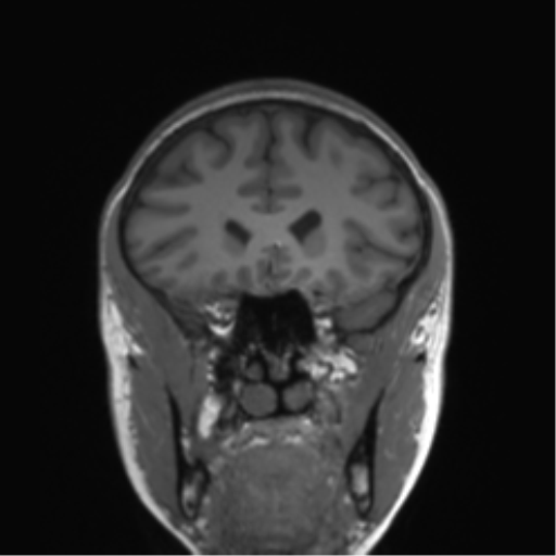 Cerebellar agenesis with hypoplastic pons (pontocerebellar hypoplasia) (Radiopaedia 57224-64138 Coronal T1 65).png