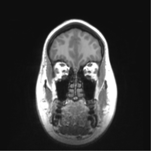 File:Cerebellar ependymoma complicated by post-operative subdural hematoma (Radiopaedia 83322-97736 Coronal T1 11).png