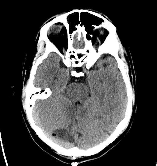 File:Cerebellar infarct due to vertebral artery dissection with posterior fossa decompression (Radiopaedia 82779-97031 Axial non-contrast 11).png