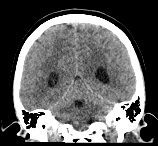 Cerebellar metastases - colorectal adenocarcinoma (Radiopaedia 40947-43652 Coronal non-contrast 64).png