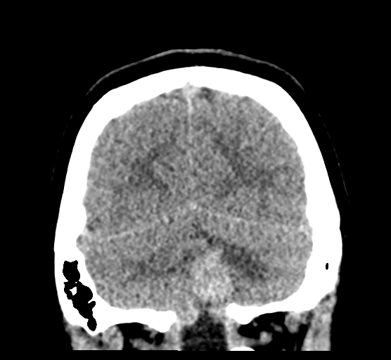Cerebellar metastases - colorectal adenocarcinoma (Radiopaedia 40947-43652 Coronal non-contrast 77).png