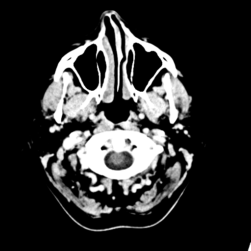 Cerebellar metastasis (Radiopaedia 54578-60812 Axial C+ 1).png