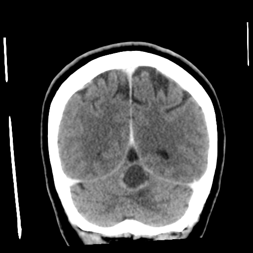 Cerebellar metastasis (cystic appearance) (Radiopaedia 41395-44258 D 47).png