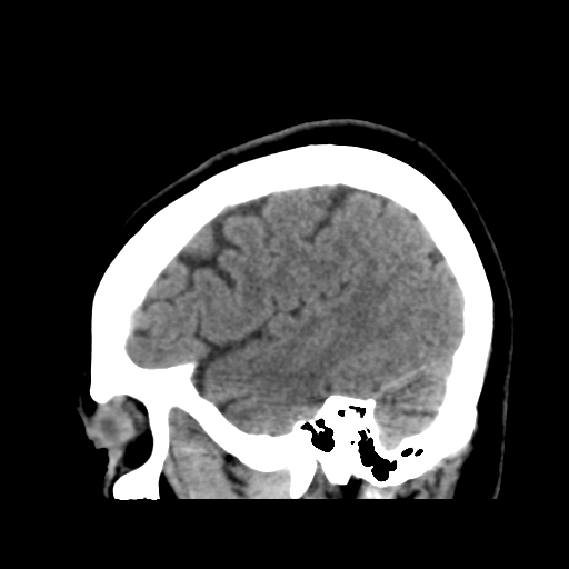 File:Cerebellar metastasis (cystic appearance) (Radiopaedia 41395-44258 E 44).png