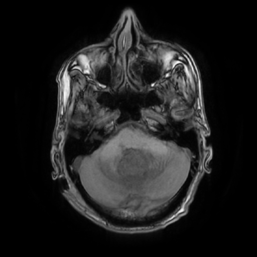File:Cerebellar metastasis - lung tumor (Radiopaedia 69317-79147 Axial T1 11).jpg
