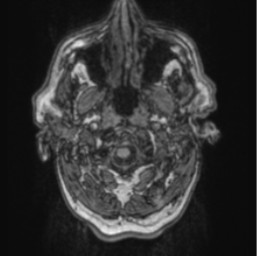 Cerebellar metastasis from lung adenocarcinoma (Radiopaedia 86690-102829 Axial T1 7).png