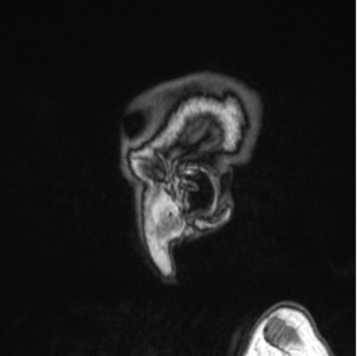 Cerebellar metastasis from lung adenocarcinoma (Radiopaedia 86690-102829 Sagittal T1 88).png