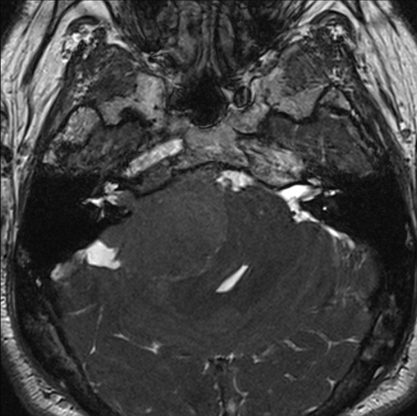 Cerebellopontine angle meningioma (Radiopaedia 24459-24764 I 23).jpg
