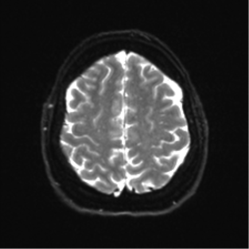 Cerebellopontine angle meningioma (Radiopaedia 48434-53348 Axial DWI 31).png
