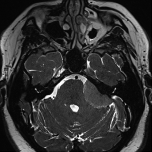 Cerebellopontine angle meningioma (Radiopaedia 48434-53348 Axial T2 Space 65).png