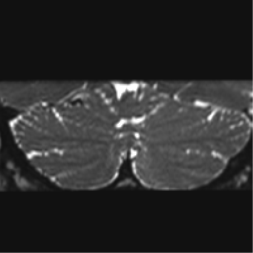 Cerebellopontine angle meningioma (Radiopaedia 48434-53348 Coronal T2 3).png