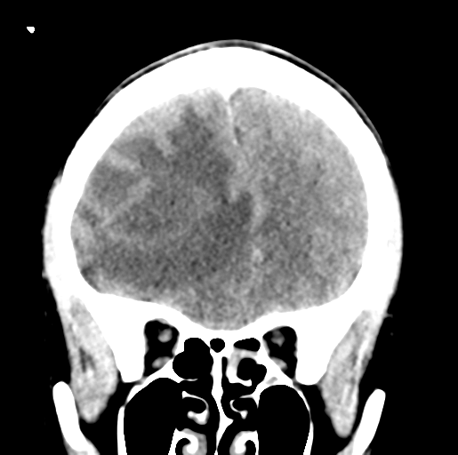 Cerebral abscess (Radiopaedia 60342-68008 Coronal non-contrast 18).png
