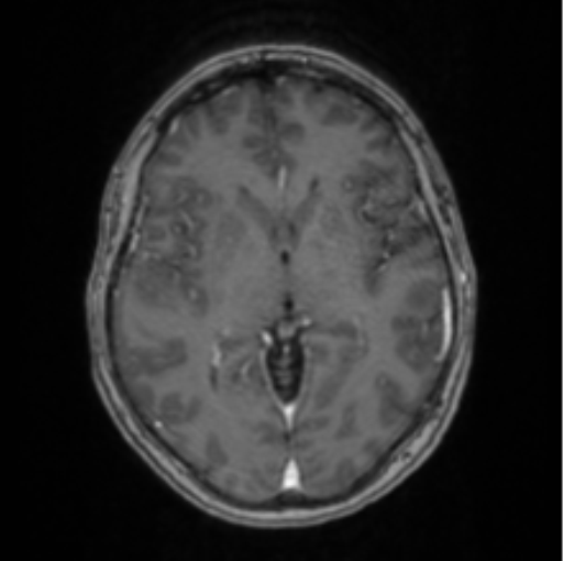 Cerebral abscess from pulmonary arteriovenous malformation (Radiopaedia 86275-102291 Axial T1 C+ 38).png