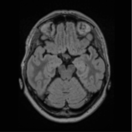 Cerebral abscess from pulmonary arteriovenous malformation (Radiopaedia 86275-102291 J 30).png