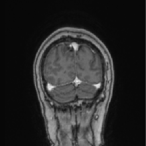 Cerebral abscess from pulmonary arteriovenous malformation (Radiopaedia 86275-102291 L 15).png