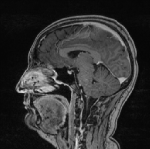 Cerebral abscess from pulmonary arteriovenous malformation (Radiopaedia 86275-102291 Sagittal T1 C+ 41).png