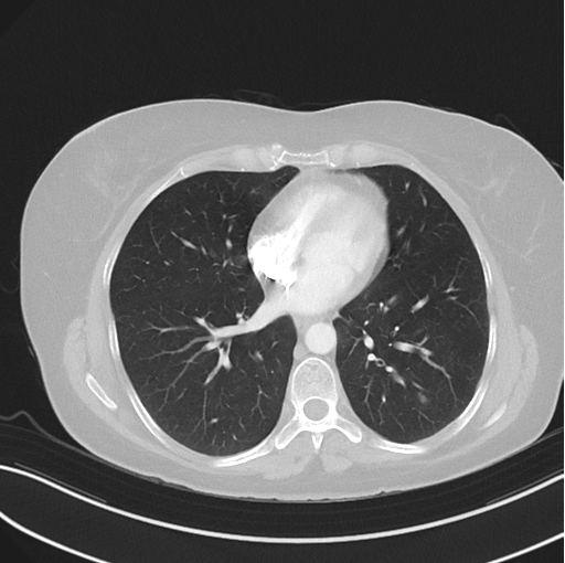 Cerebral abscess from pulmonary arteriovenous malformation (Radiopaedia 86275-102292 Axial lung window 36).png