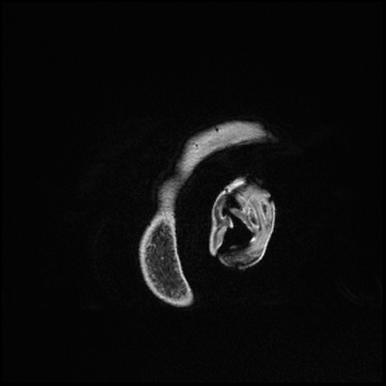 Cerebral abscess with ventriculitis (Radiopaedia 78965-91878 Sagittal T1 C+ 180).jpg