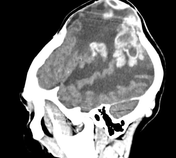 Cerebral abscesses (Radiopaedia 70458-80568 Sagittal Contrast 14).jpg