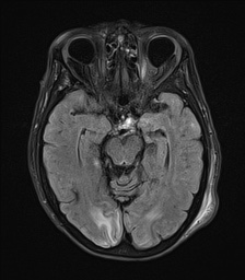 File:Cerebral amyloid angiopathy-related inflammation (Radiopaedia 74836-85849 Axial FLAIR 12).jpg