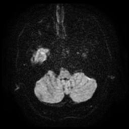 File:Cerebral amyloid angiopathy (Radiopaedia 28698-28978 Axial DWI 5).jpg