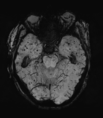 Cerebral amyloid angiopathy (Radiopaedia 46082-50433 Axial SWI MIP 25).png