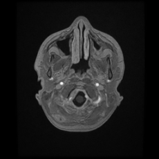 Cerebral and spinal tuberculosis (Radiopaedia 90489-107837 Axial T1 C+ 30).jpg