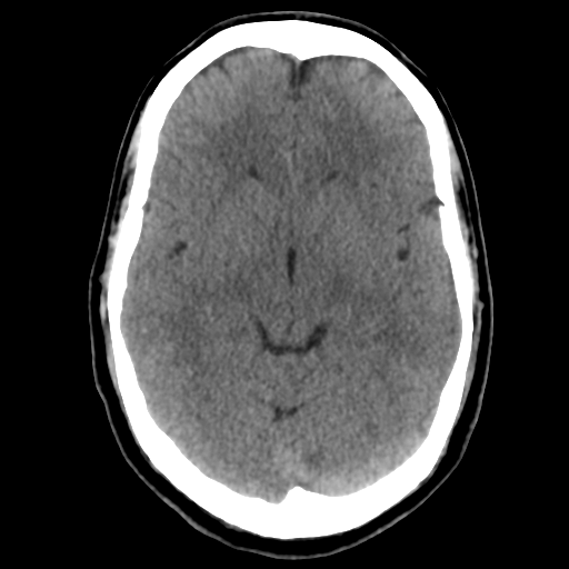 File:Cerebral arteriovenous malformation (Radiopaedia 39259-41505 Brain Ax 5mm 12).png
