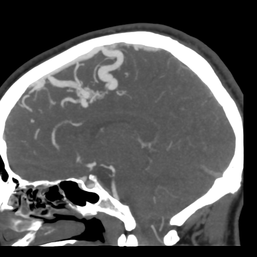 Cerebral arteriovenous malformation (Radiopaedia 39259-41505 Sagittal 29).png