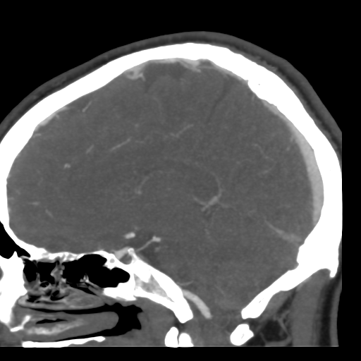 Cerebral arteriovenous malformation (Radiopaedia 39259-41505 Sagittal 34).png