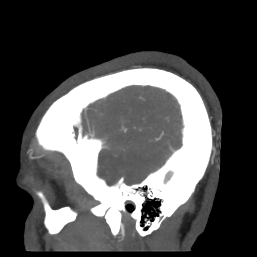 File:Cerebral arteriovenous malformation (Radiopaedia 39259-41505 Sagittal 54).png